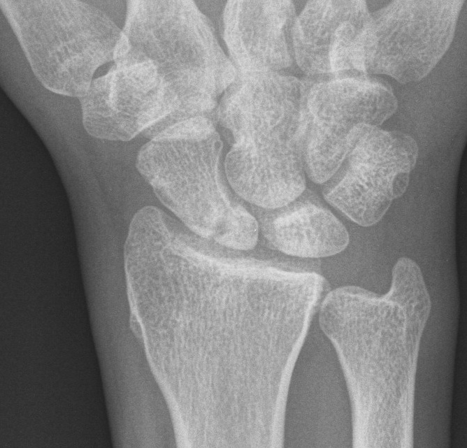 Scaphoid Proximal Pole Fracture